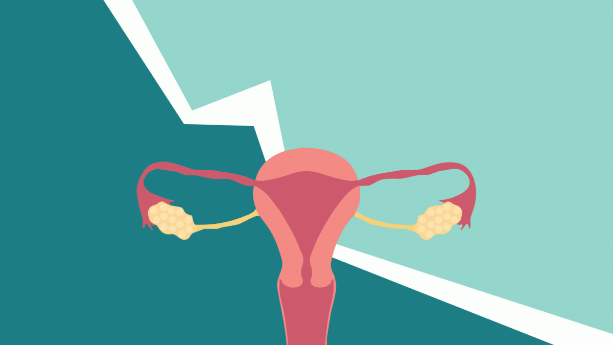 There Are 4 Stages of Endometriosis. Here's What Each One Means