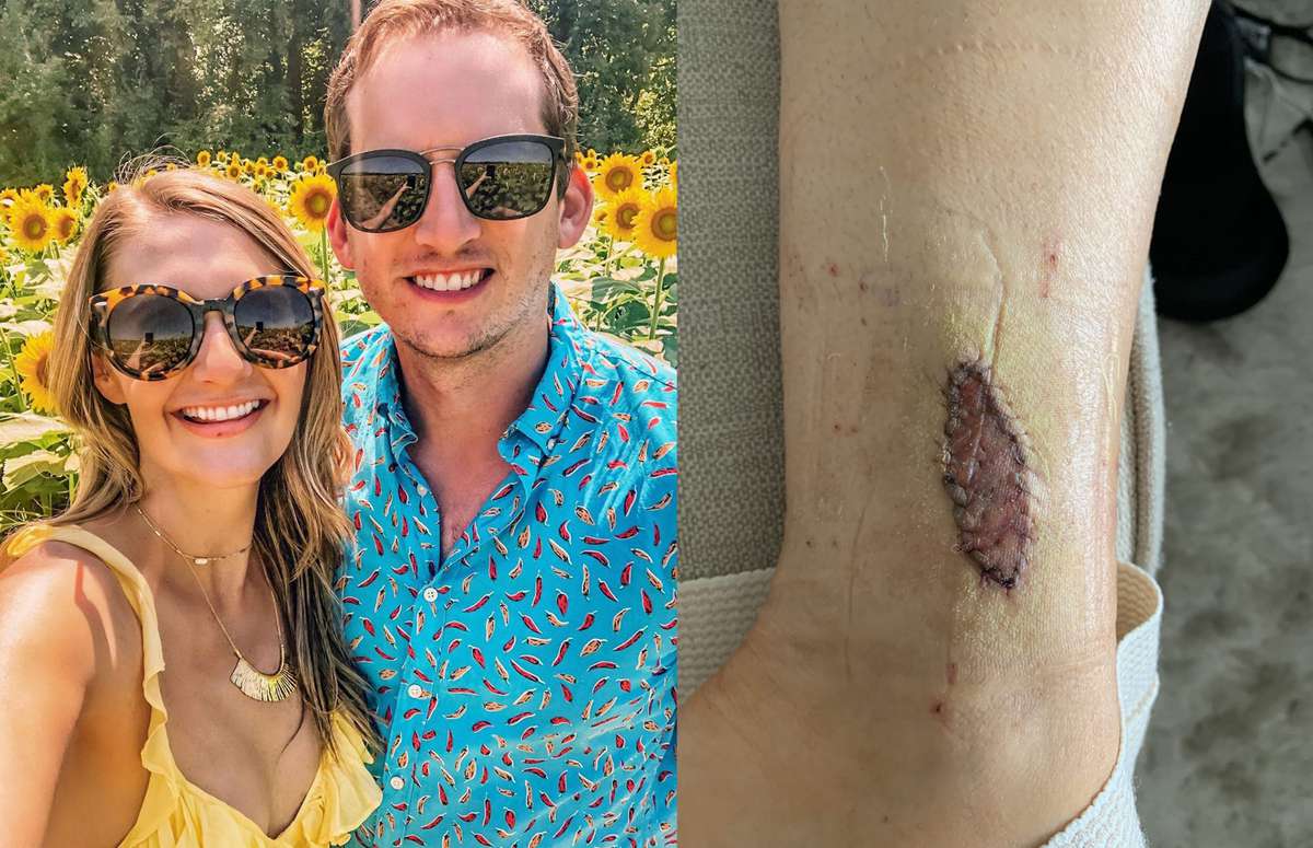 This Influencer's Birthmark Turned Out to Be Melanoma: 'I Could Feel It Growing'