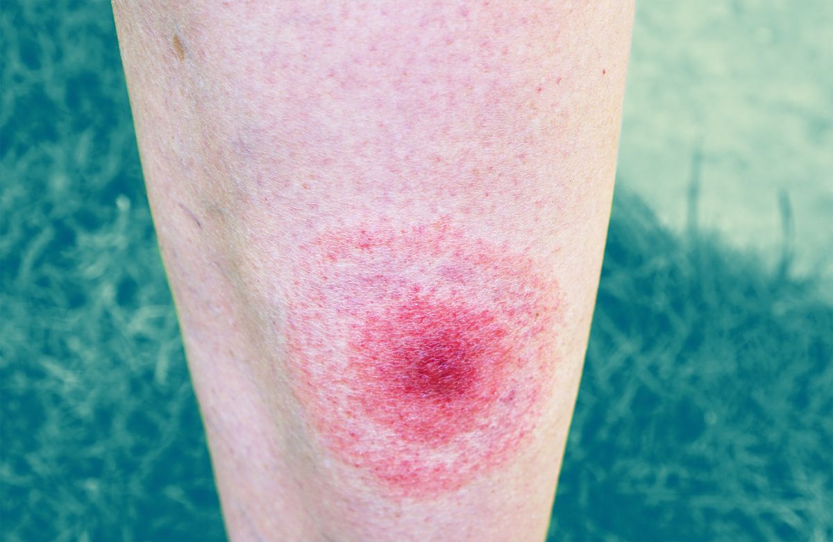 5 Types of Rashes That Can Be Signs of Lyme Disease