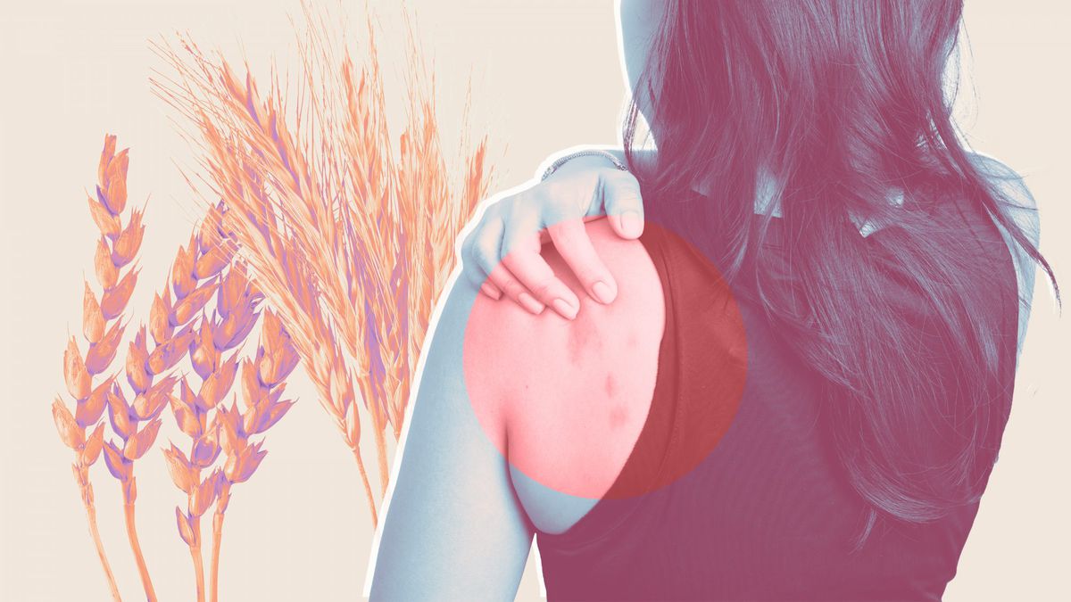 Some Patients With Celiac Disease Rash Say They're So Itchy, 'They Want to Take Their Skin Off'