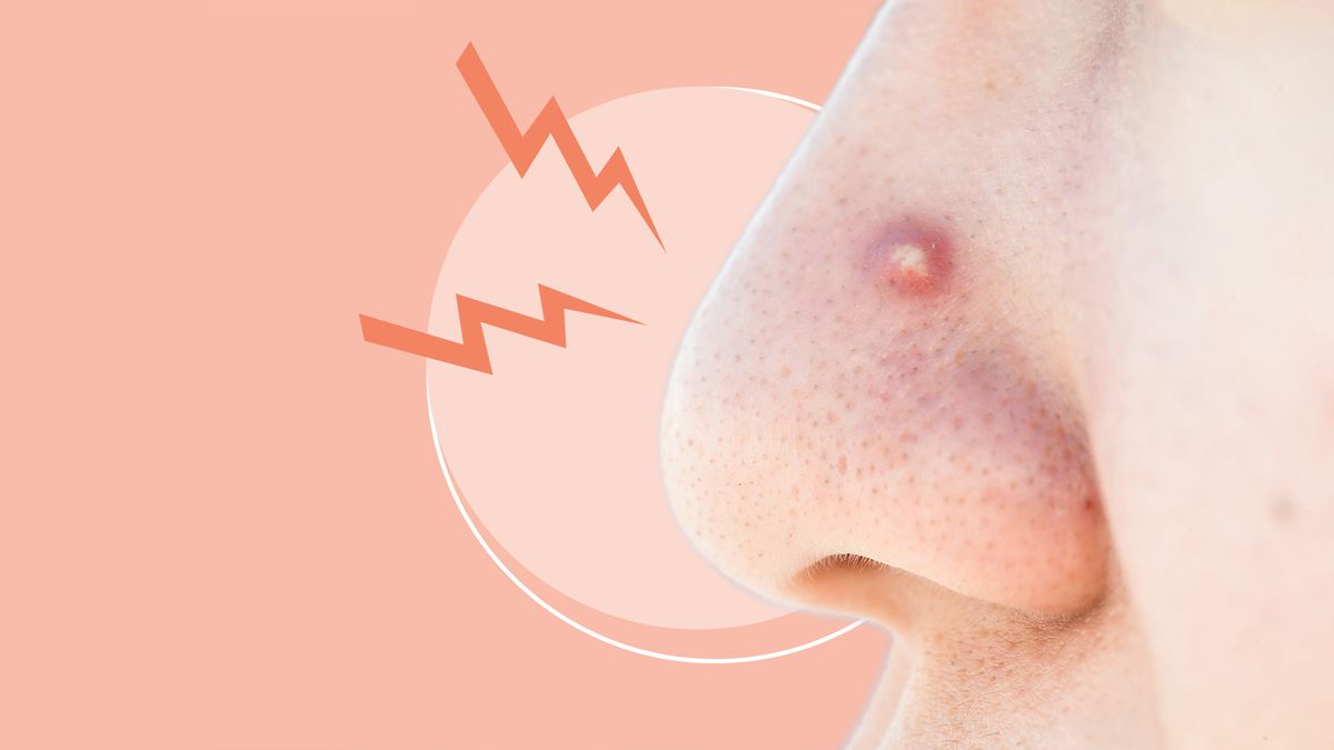The 'Triangle of Death' Is the One Place on Your Face Where You Should Never, Ever Pop Pimples