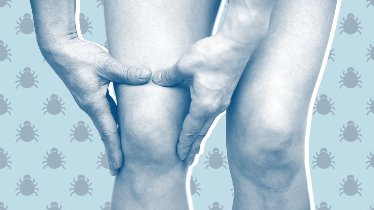 14 Signs You May Have Lyme Disease