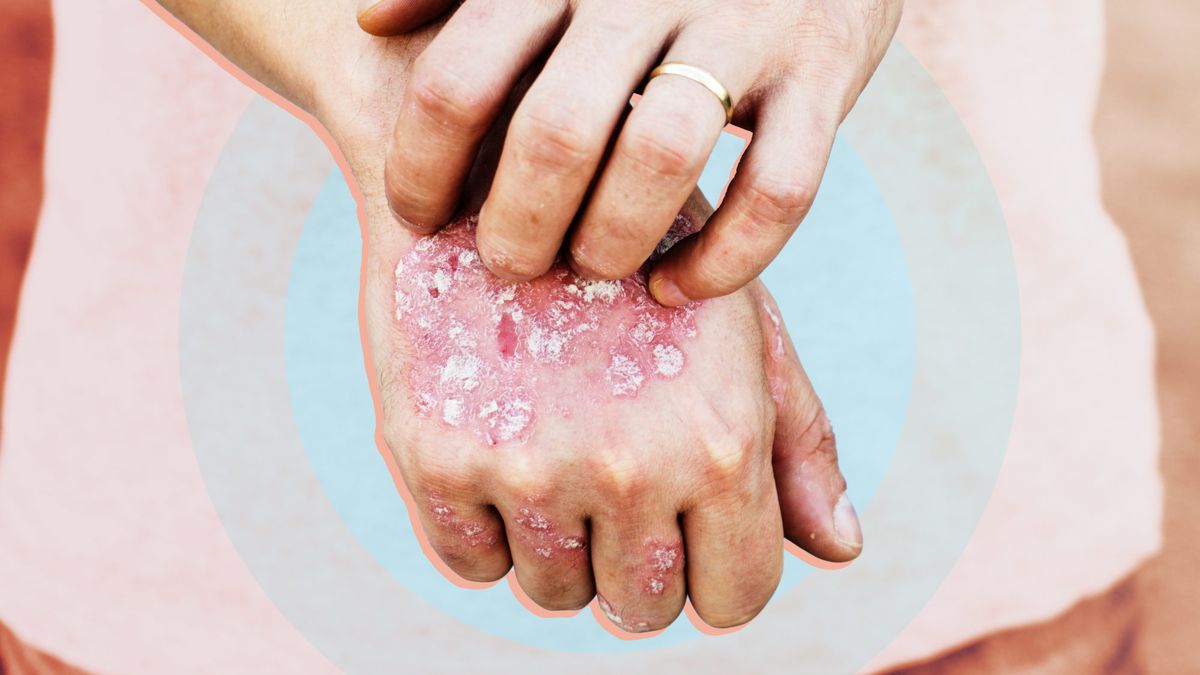 What Is Plaque Psoriasis? How Doctors Diagnose and Treat This Chronic Skin Condition