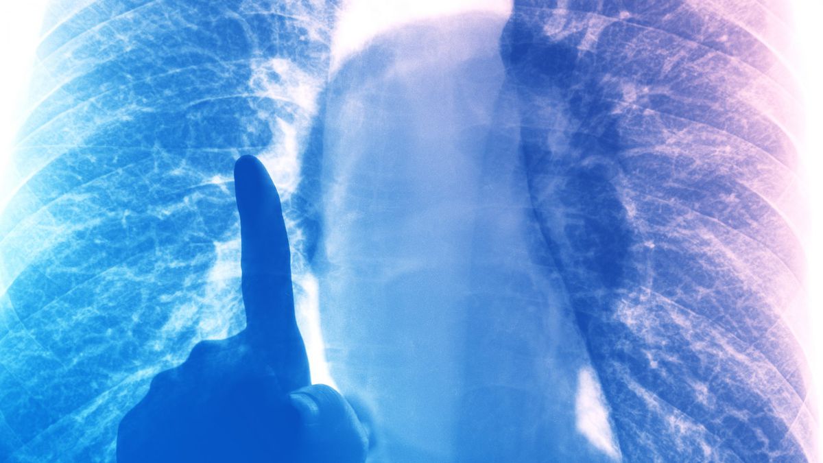 What Is Interstitial Lung Disease? What to Know, According to Pulmonologists