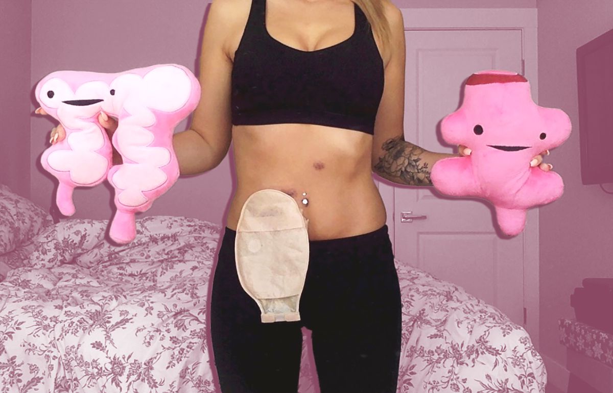 This 24-Year-Old Shares How She Lost Her Colon and Rectum to IBD in Viral TikTok Video