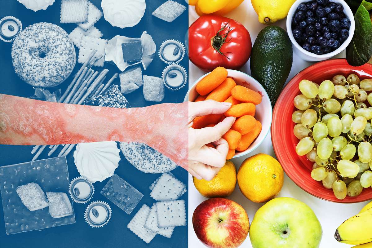5 Foods to Eat If You've Got Psoriasis, and 5 to Limit, According to Experts