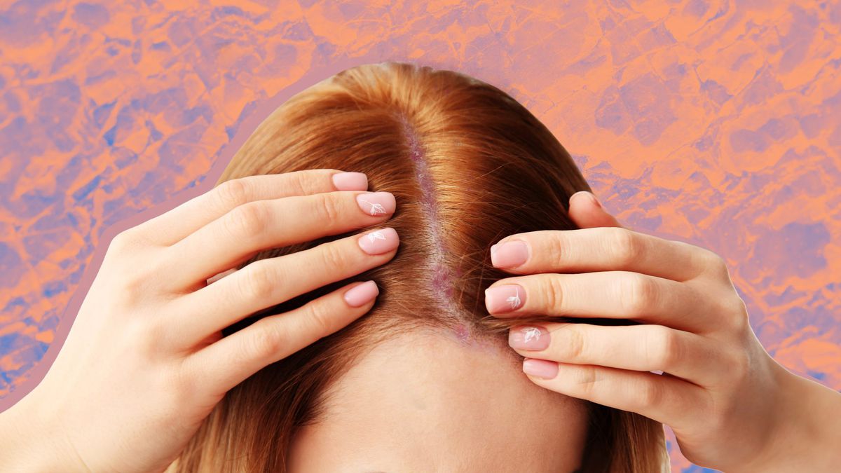 How to Deal With Scaly, Plaque Psoriasis Patches on Your Scalp, According to Dermatologists