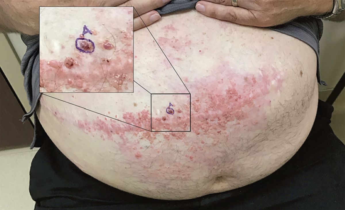 This Man Thought He Had Shingles, But His Colon Cancer Had Spread to the Surface of His Skin