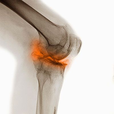 3 Common Knee Surgeries, Explained