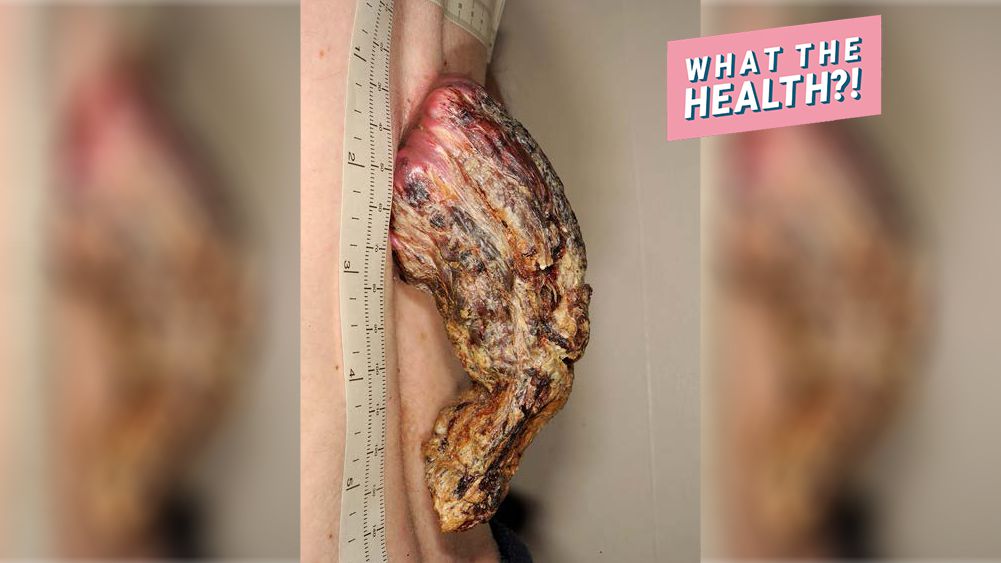 This Man Had a 5-Inch 'Dragon Horn' Growing Out of His Back After Ignoring Skin Cancer for 3 Years