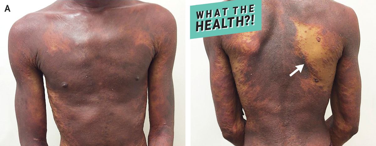 This Man Went To The Doctor For A Rash And It Turned Out He Had Hiv Health Com