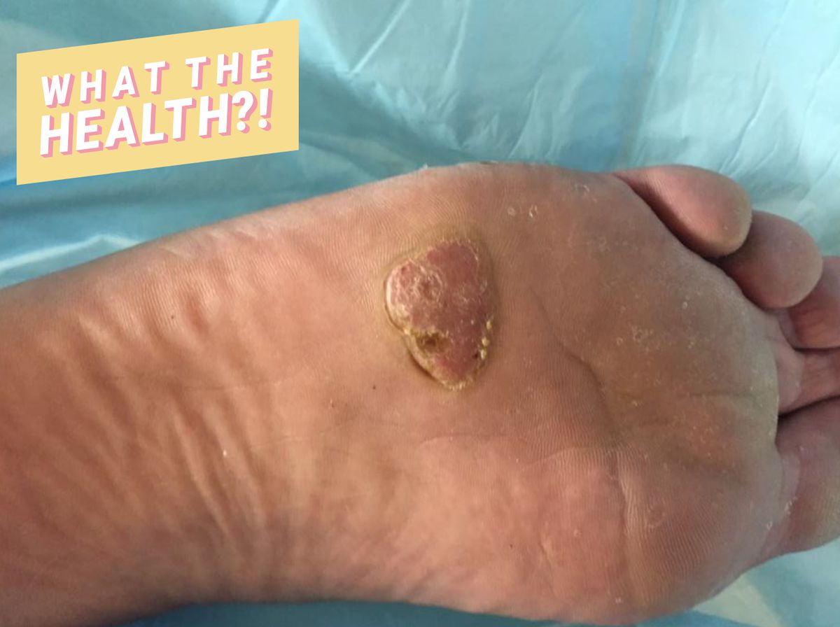 This Man Discovered the 20-Year-Old Wart on His Foot Was Actually Skin Cancer