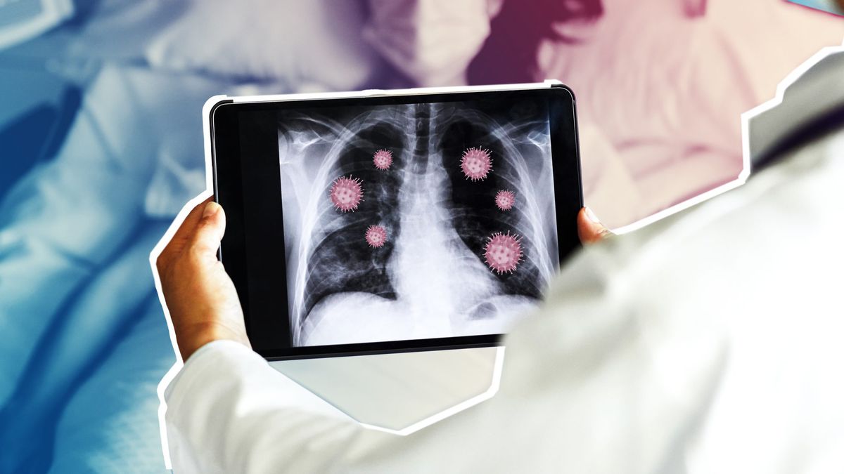 COVID-19 Can Cause Pneumonia—Here's What to Know, According to Experts