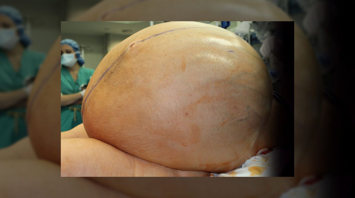 This 38-Year-Old Woman Had an 132-Pound Ovarian Tumor Removed