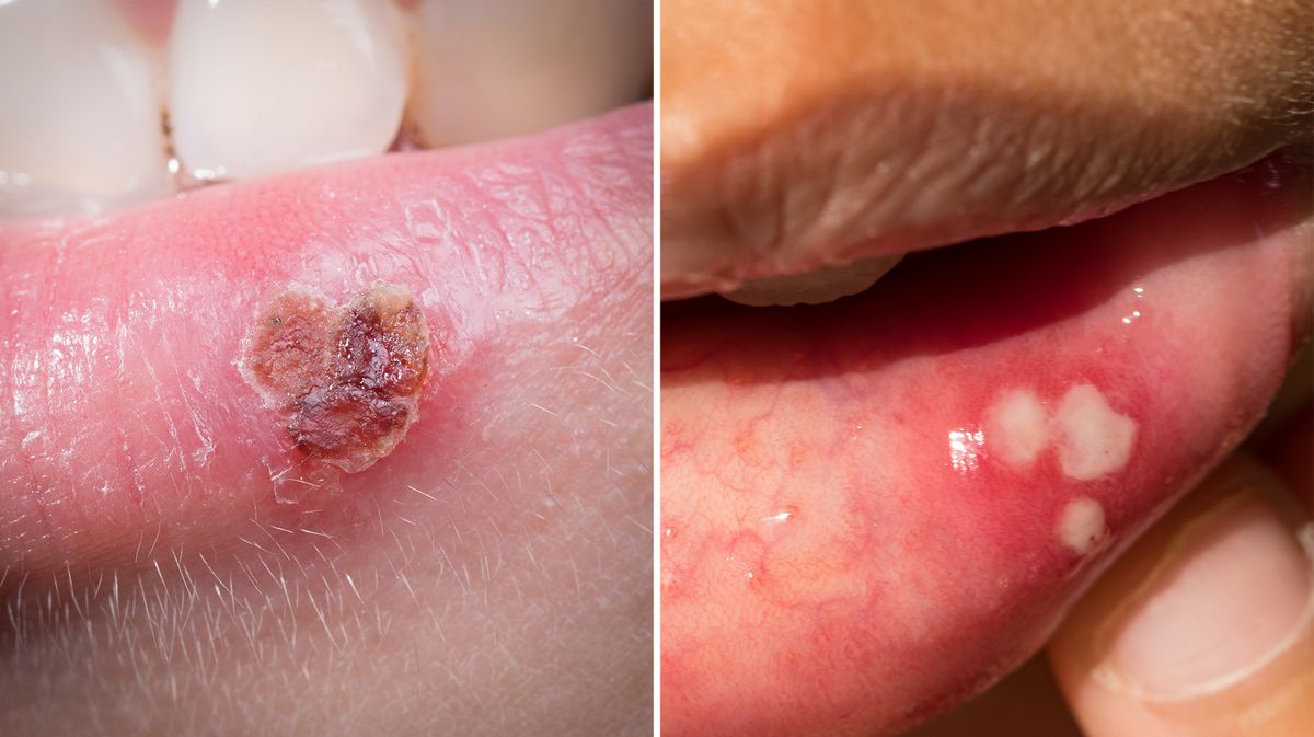 hpv in mouth vs canker sore