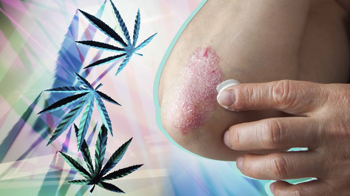 Can CBD Relieve Psoriasis Symptoms? Here's What Doctors Are Saying