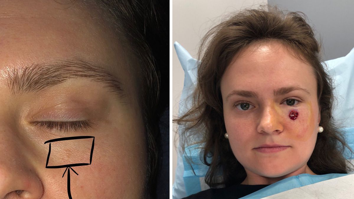 This 24-Year-Old Thought the Tiny Spot Under Her Eye Was a Pimple&mdash;But It Was Actually Skin Cancer