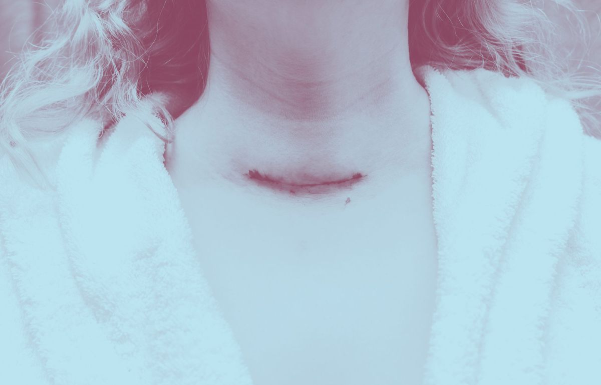 I Survived Thyroid Cancer&mdash;but Dealing With the Side Effects Has Been Harder Than I Ever Imagined