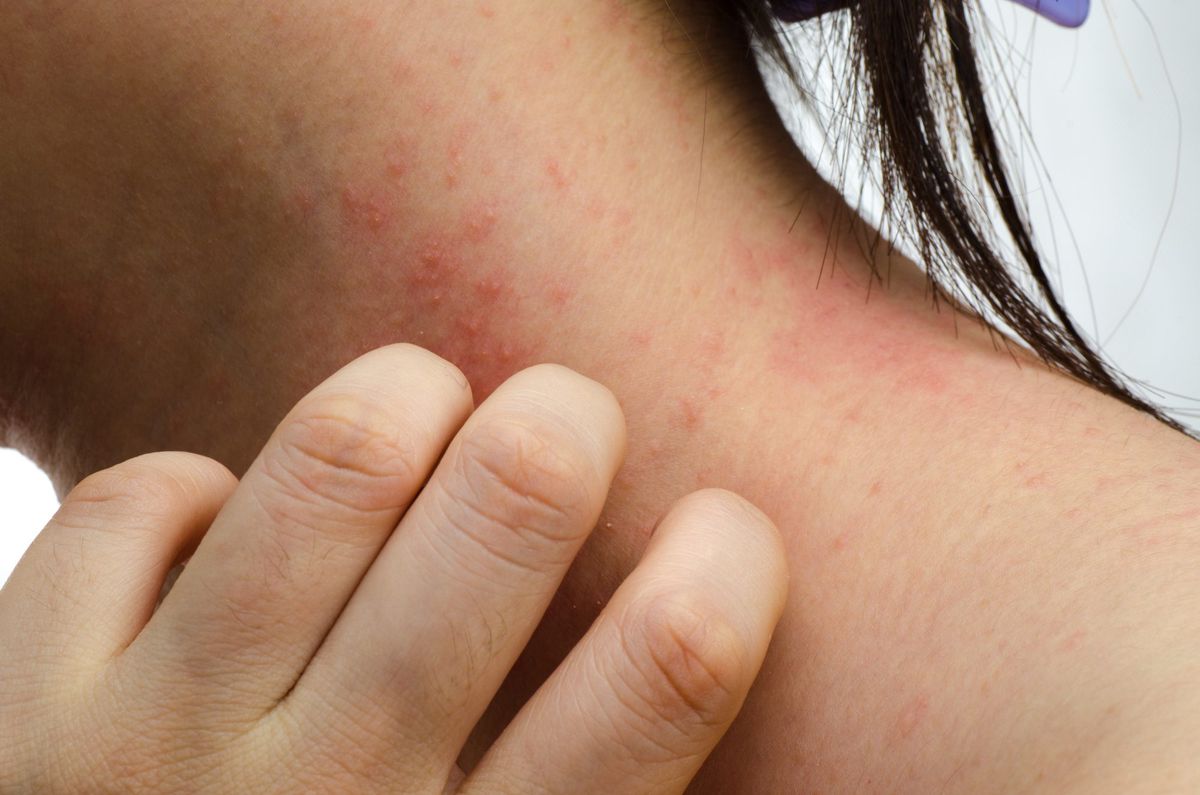 What to Do Next If Over-the-Counter Eczema Treatment Doesn't Work