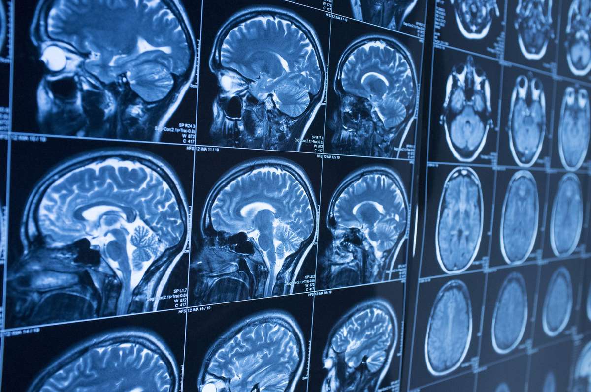 A 13-Year-Old Died After a Sinus Infection Traveled to His Brain. How Does That Happen?