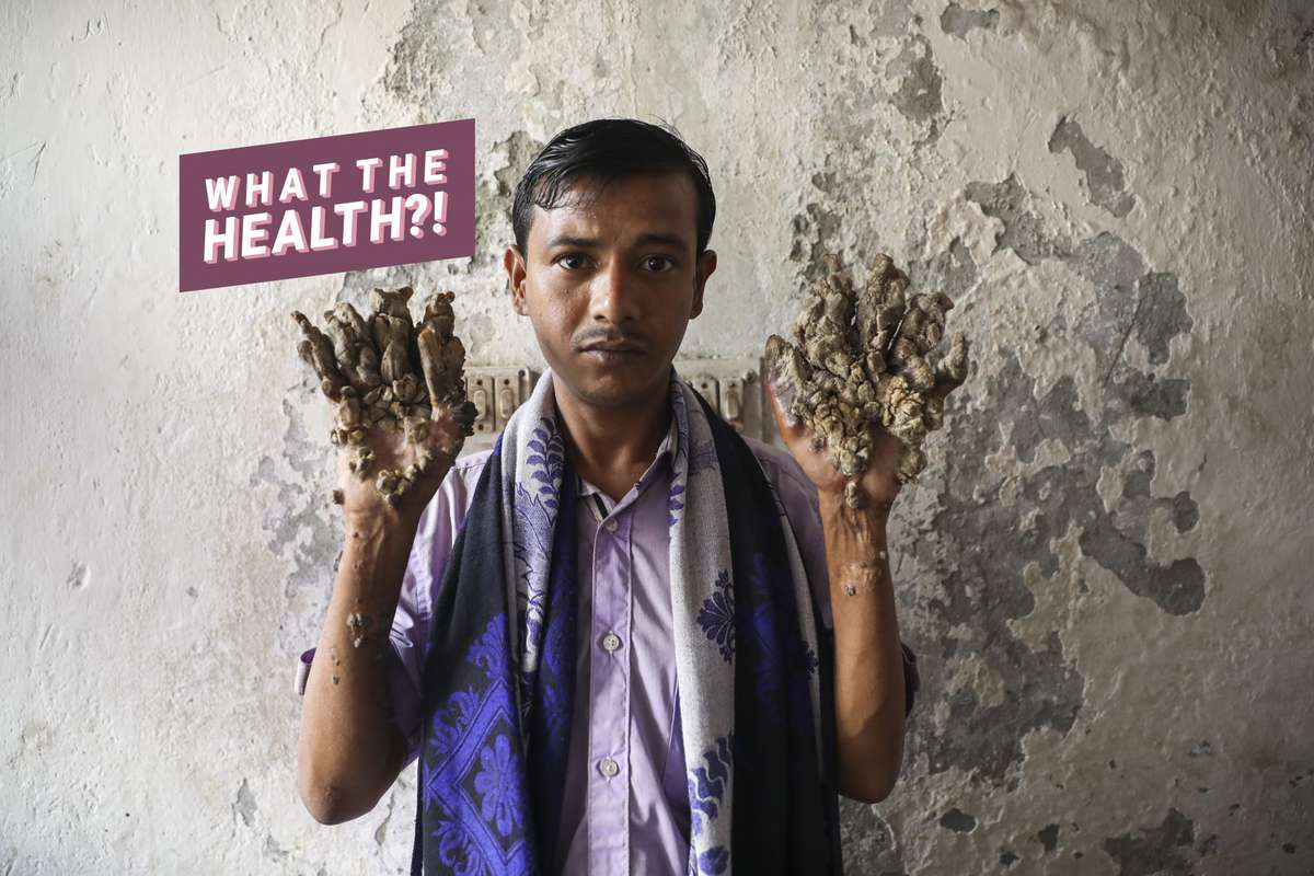 'Tree Man' Has Had 25 Surgeries for Rare Condition That Causes Branch-Like Growths on His Body