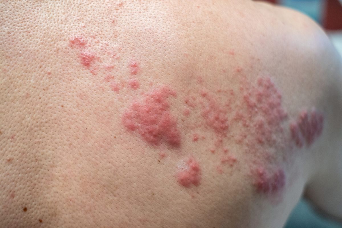 What Actually Causes Shingles&mdash;and How You Can Prevent It