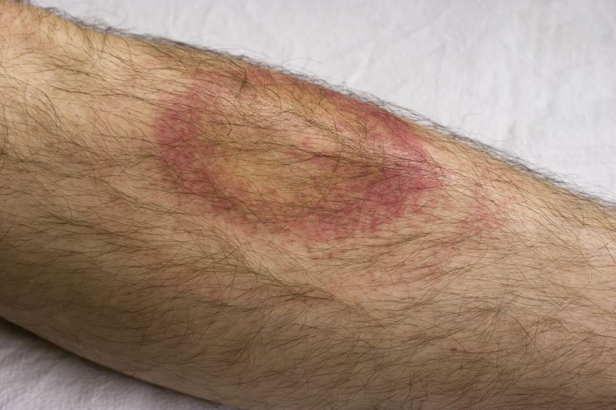 The Lyme Disease Complication You Don't Know About&mdash;but Should