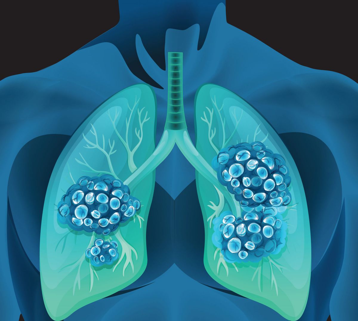 The Difference Between Small Cell and Non-Small Cell Lung Cancer