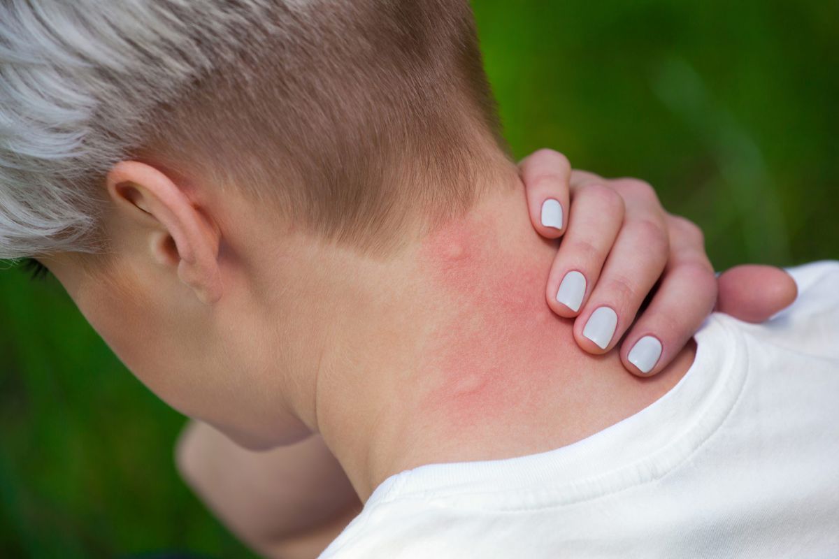 What Is A Stress Rash How To Treat One Health Com
