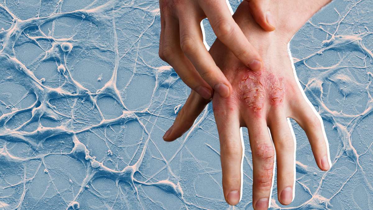 Why It's So Important to Know Your Cancer Risk if You Have Psoriasis