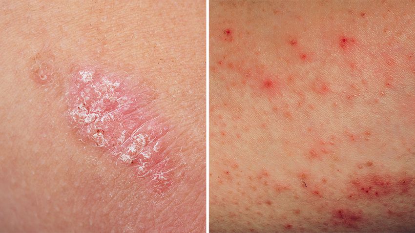 The Key Differences Between Eczema and Psoriasis You Need to Know