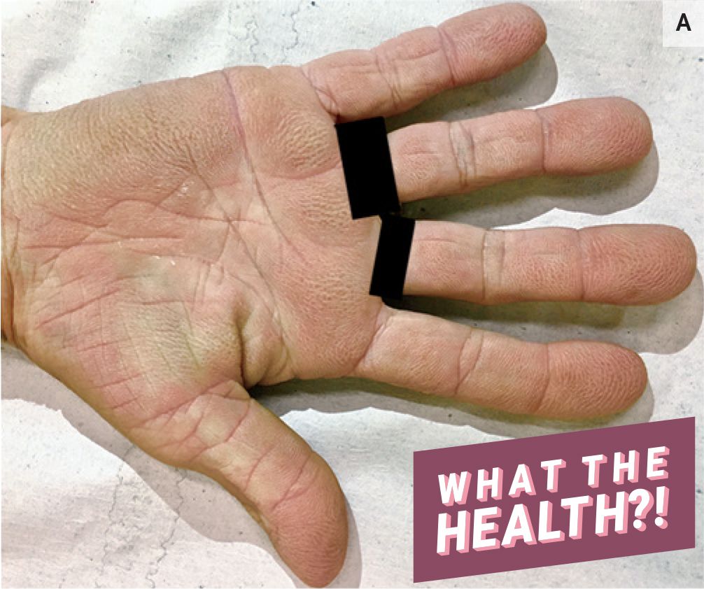 The Strange 'Velvety' Appearance of This Woman's Palms Was Actually a Sign of Lung Cancer