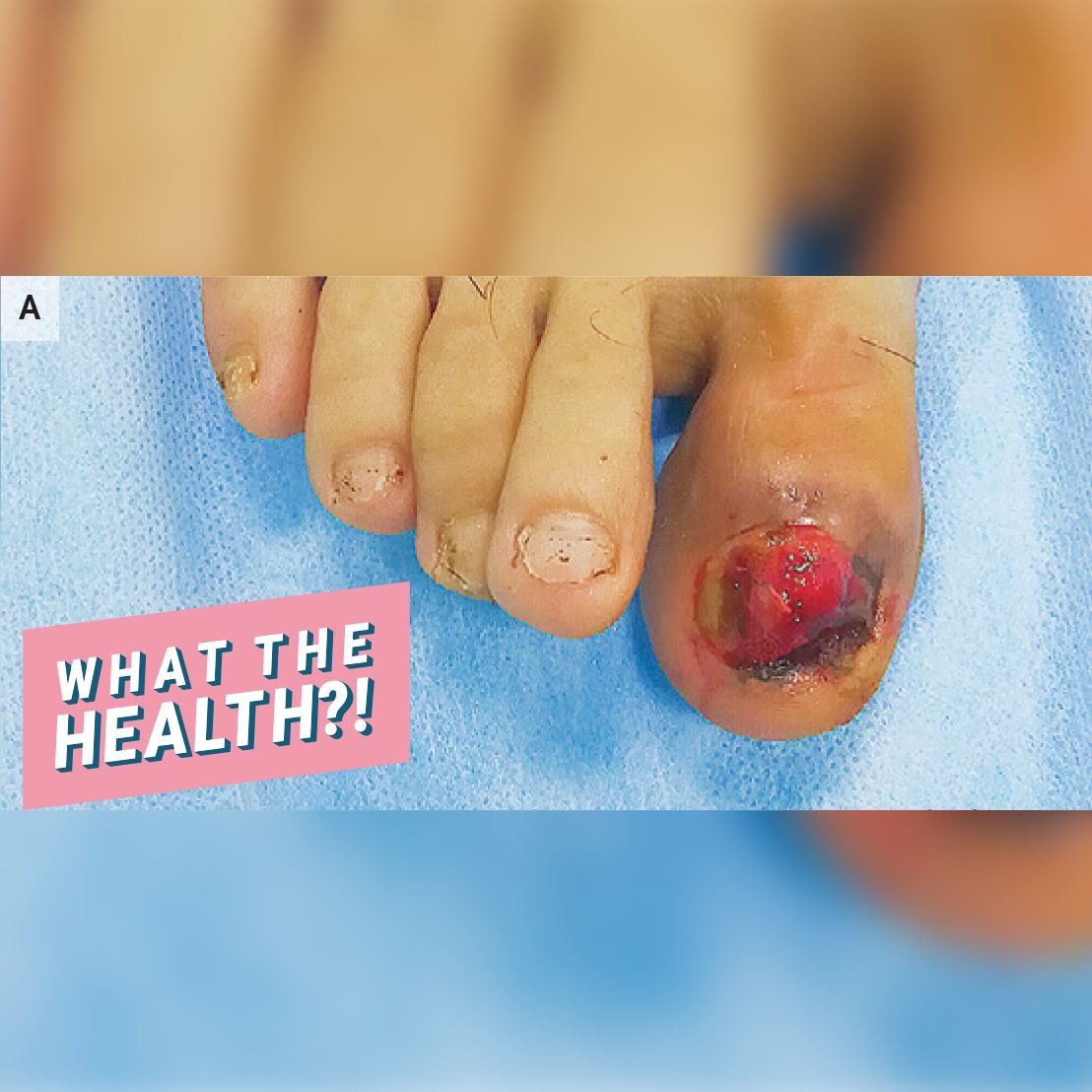 This Man's Toe Started Bleeding After Someone Stepped On It&mdash;But It Turned Out to Be a Symptom of Melanoma