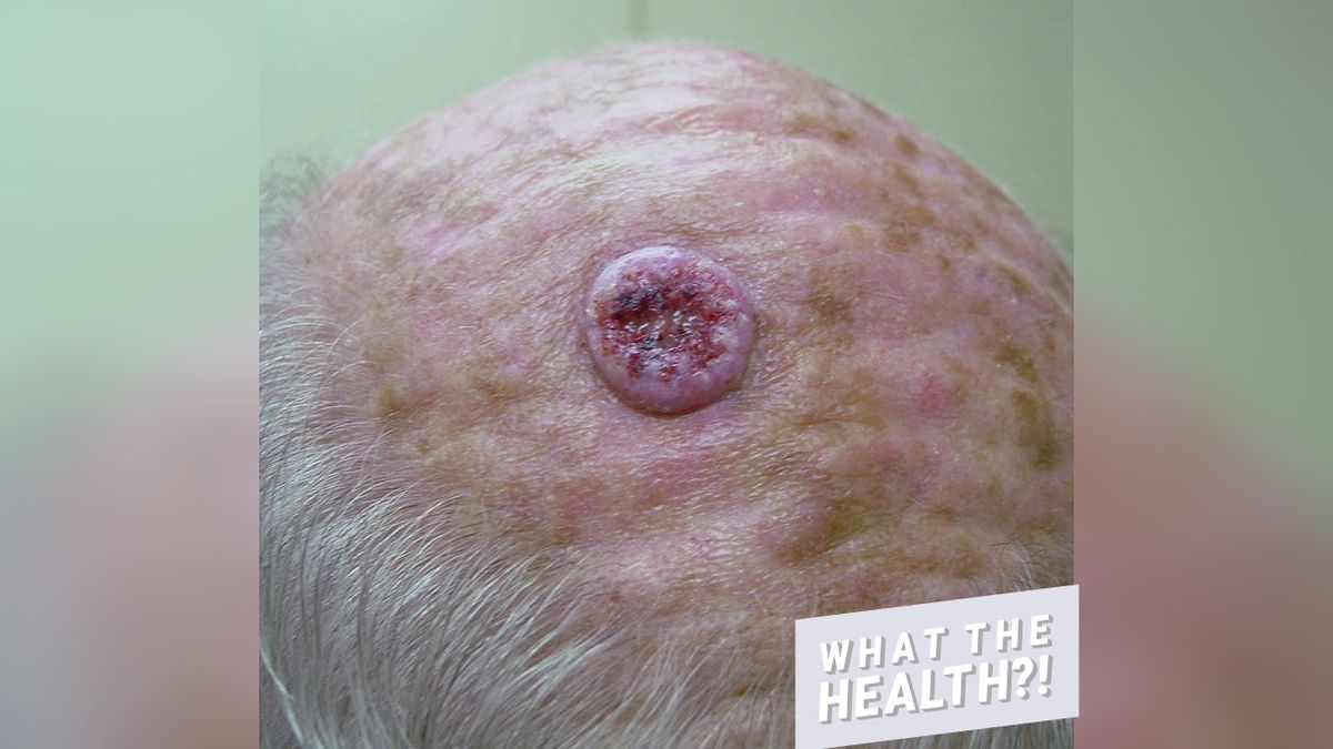 This Photo of a Bloody Hole in a Man's Head From Skin Cancer Is a Serious Wake-Up Call