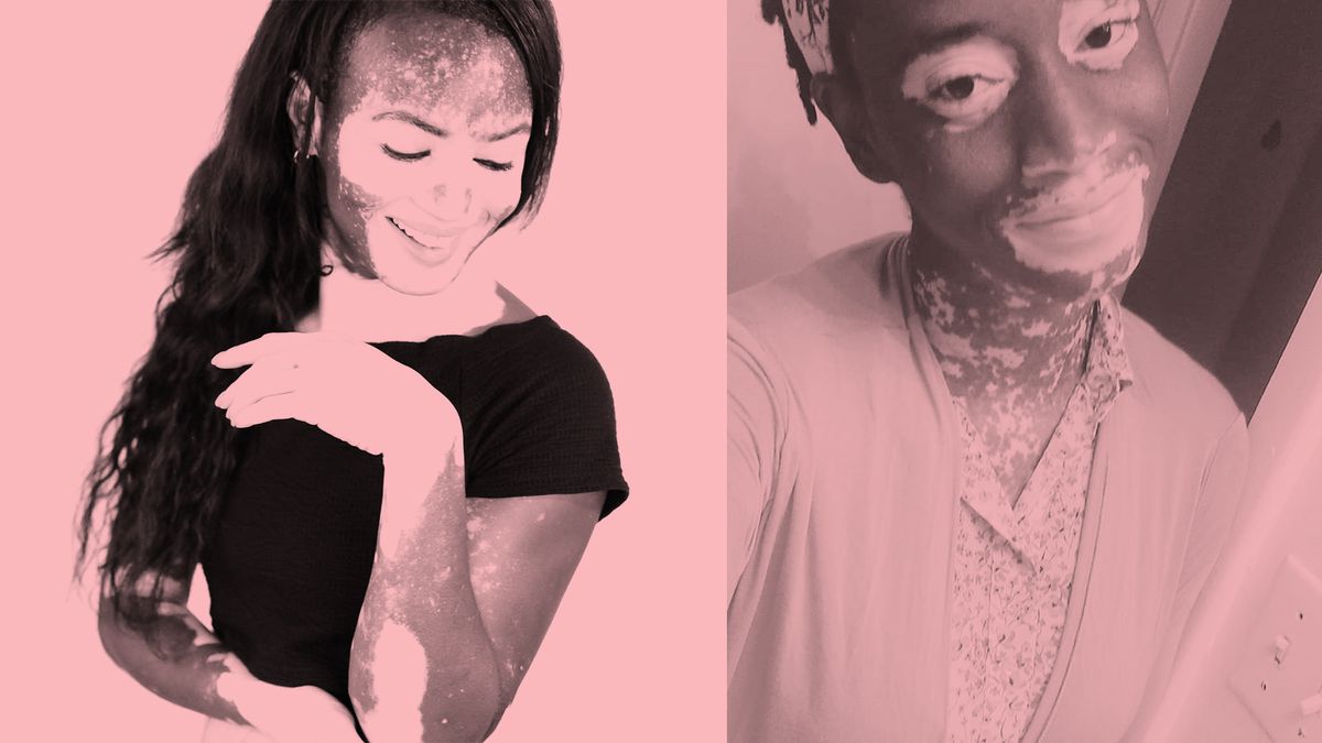 How These 7 Women With Vitiligo Are Embracing Their Skin