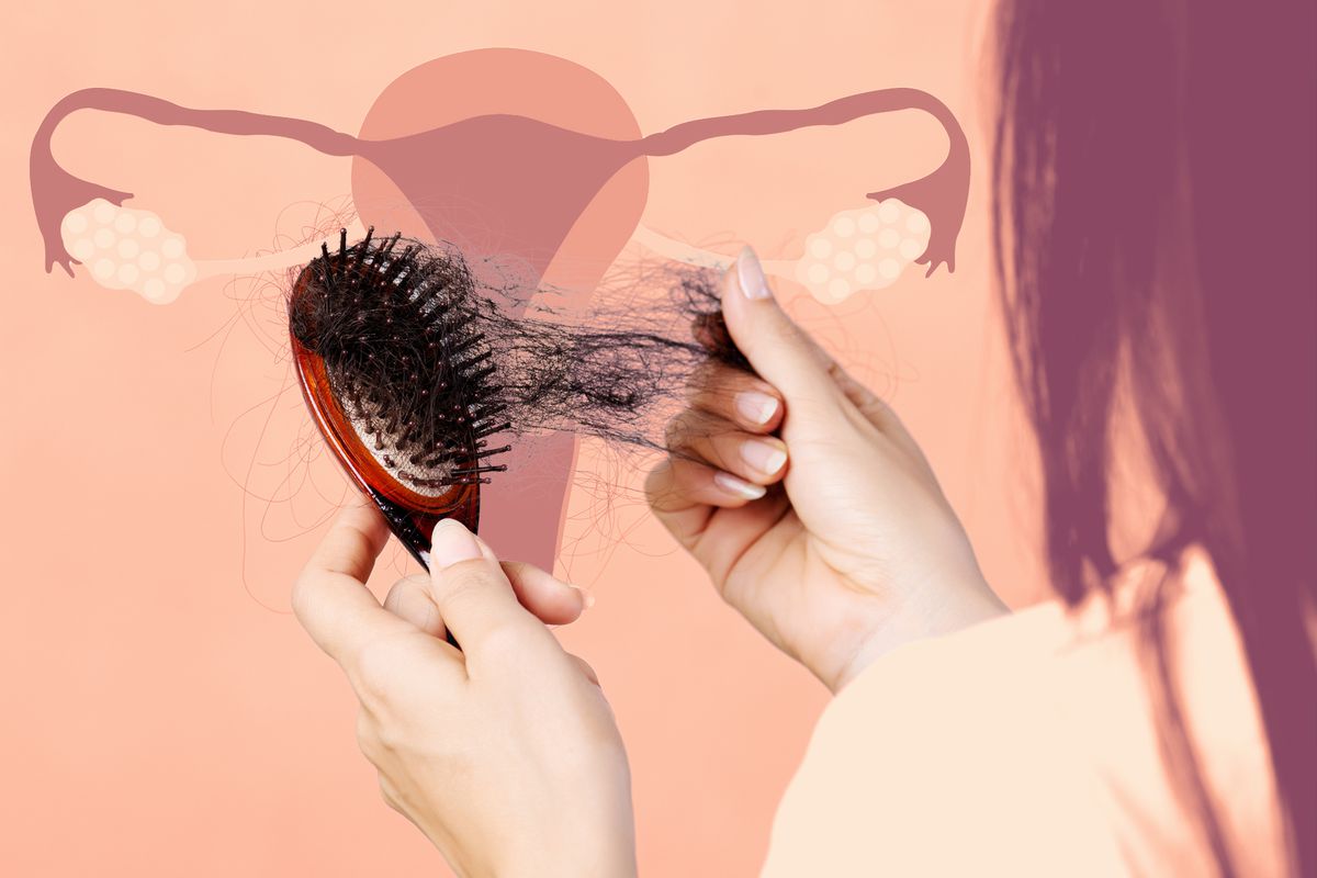 How PCOS Can Cause Hair Loss—And What to Do About It, According to Experts