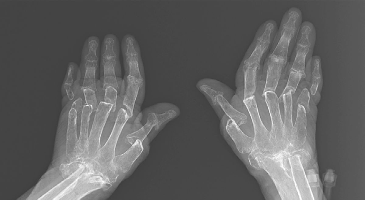 This X-Ray of a Woman's 'Telescoping Fingers' Shows the Painful Reality of Living With Rheumatoid Arthritis
