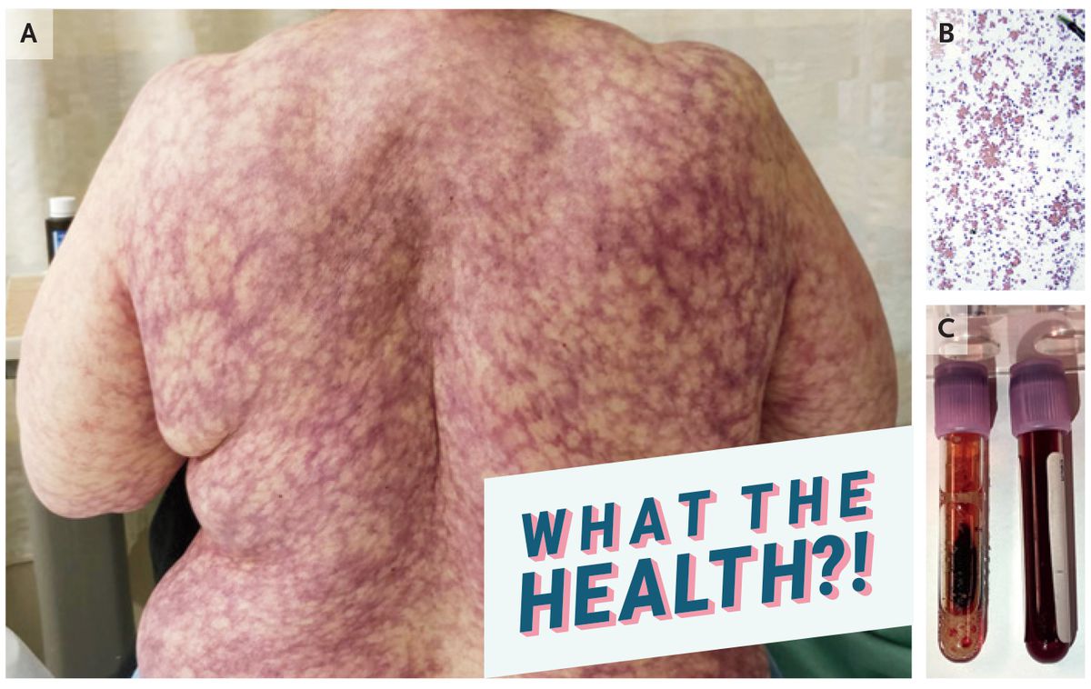 This Woman's Back is Covered in a Purple, "Netlike" Rash&mdash;and Doctors Say It Could Be From Cold Weather
