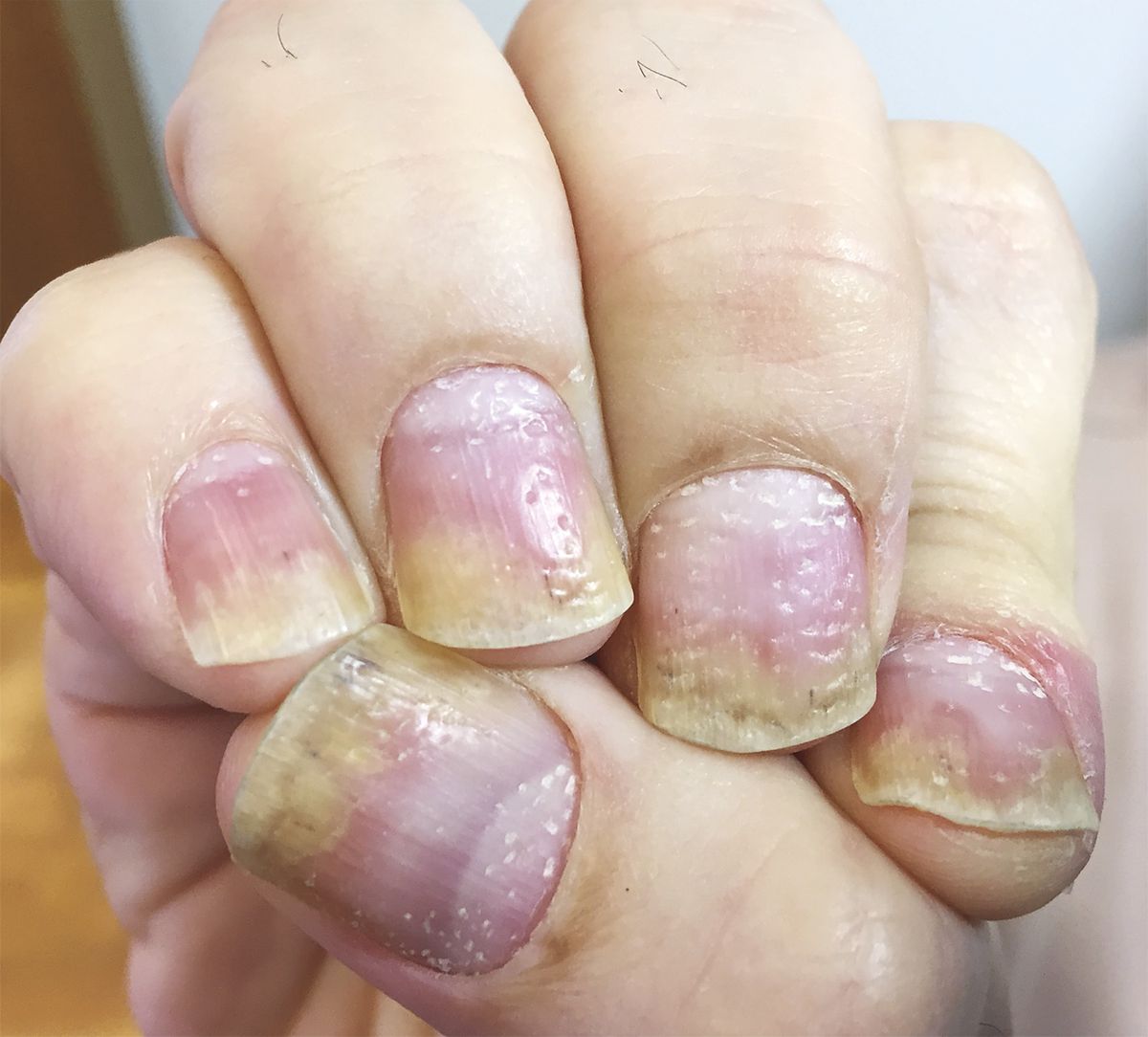 This Man's Nails Look Dented&mdash;but Are Actually a Symptom of Something More Serious