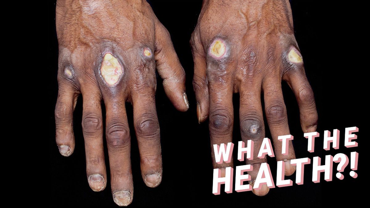 The Large, Painful Sores on This Man's Hands Were Caused By An Extremely Rare Inflammatory Disease
