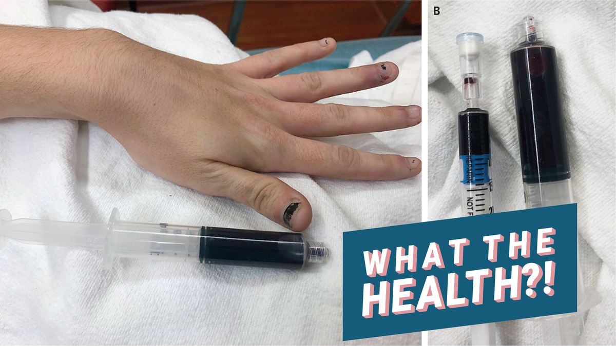 This Girl's Blood and Skin Turned Blue After Using a Topical Anesthetic&mdash;Here's Why
