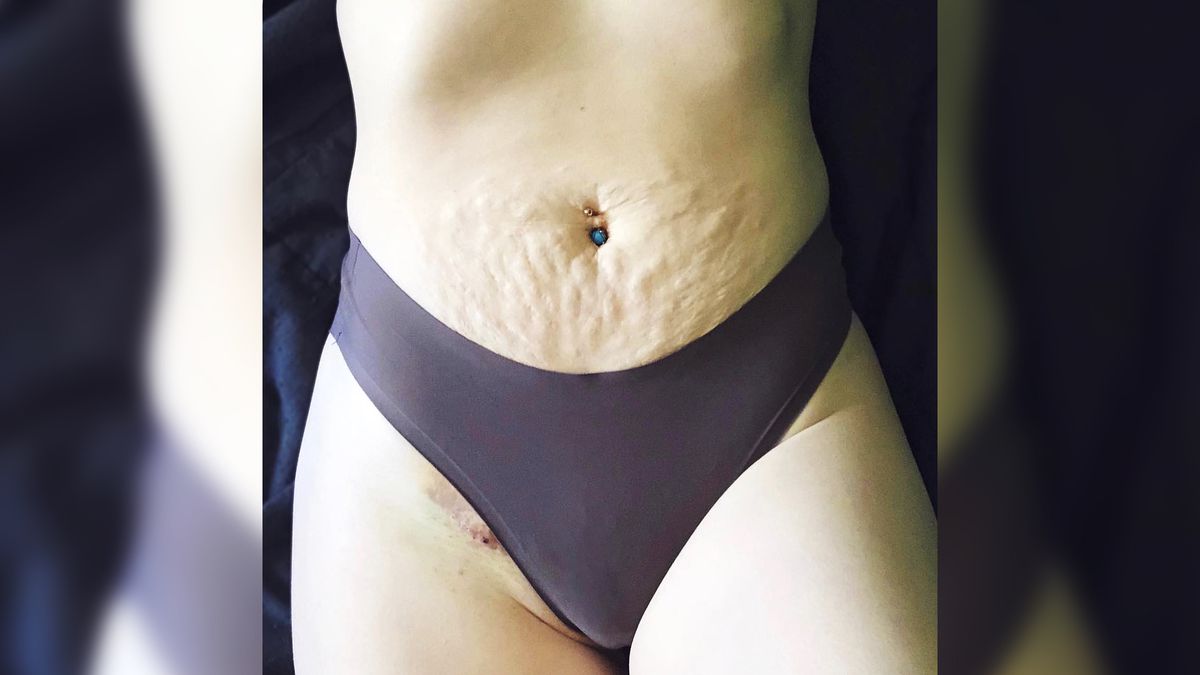 This Mom Shared a Revealing Photo of Her Bikini-Line Scar for a Powerful Re...