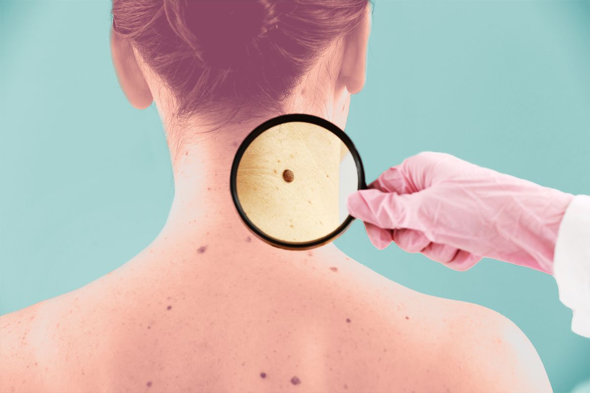 Cancerous Moles Are the Most Dangerous Form of Skin Cancer-Here's What to Know