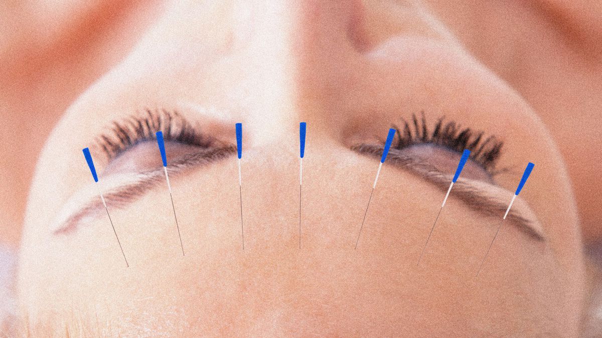 is-zoom-acupuncture-a-scam-or-the-next-diy-wellness-phenomenon