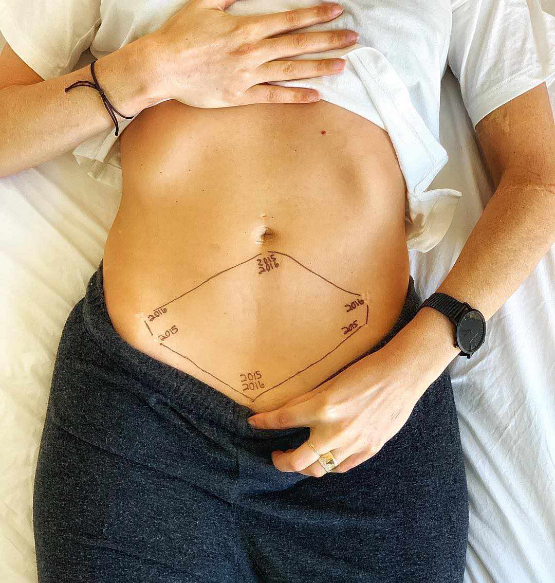 Women Are Sharing Unedited Belly Scar Photos to Show a Side of Endometriosis You Don't Usually See