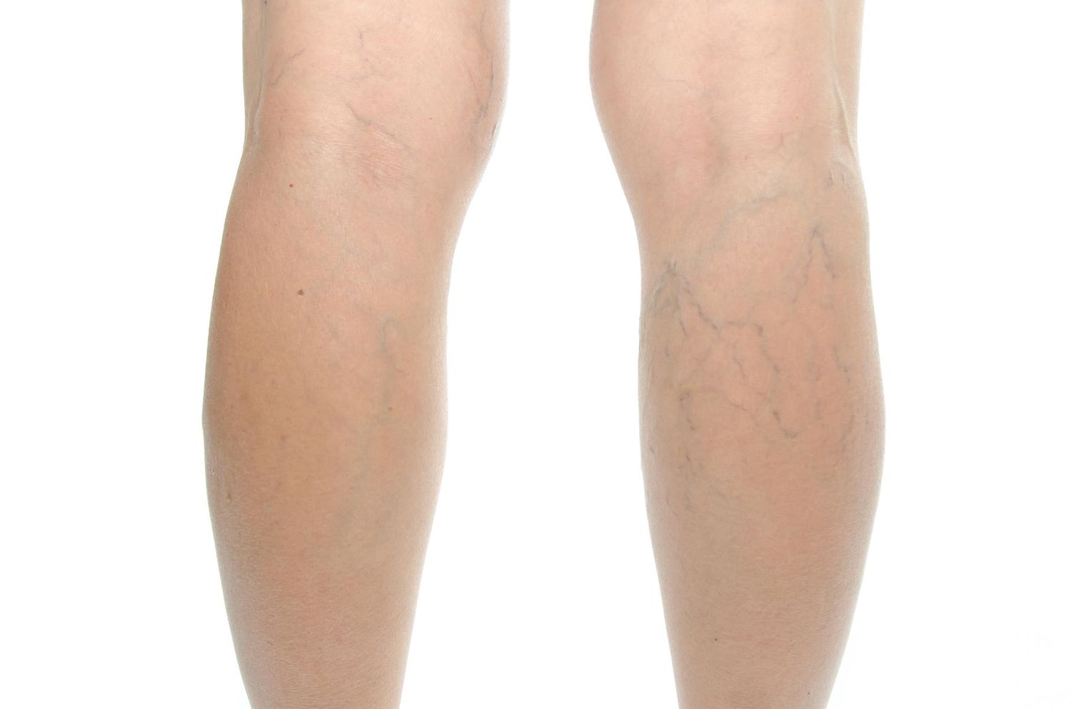 how common are varicose veins in pregnancy