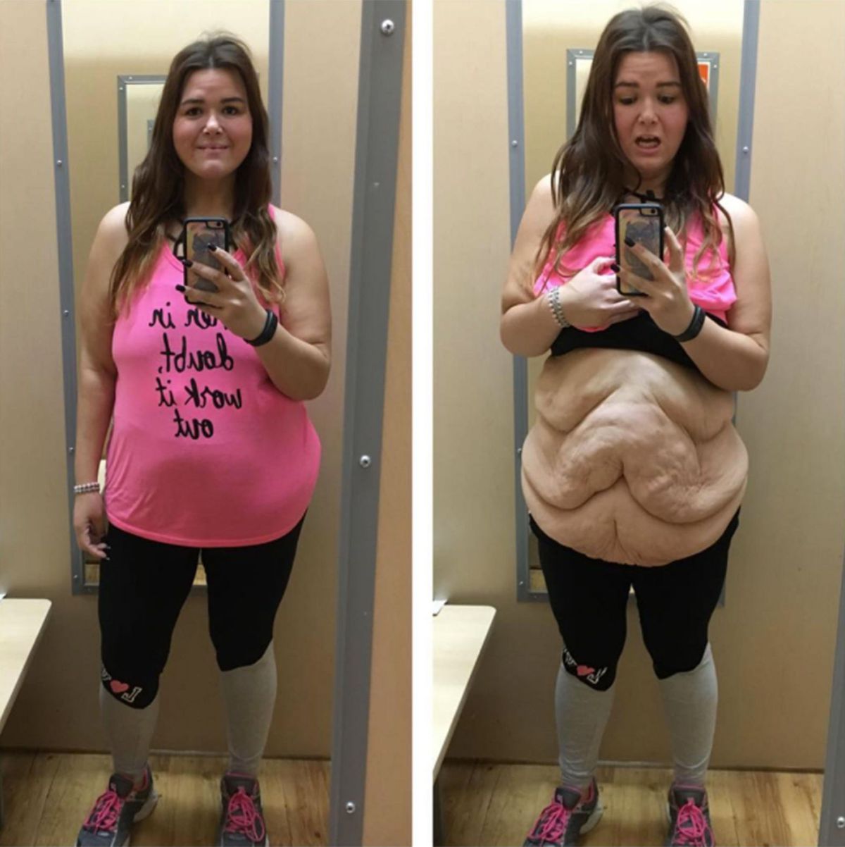 Shows Off Excess Skin: 'I Wanted People to Realize What Obesity Does&a...