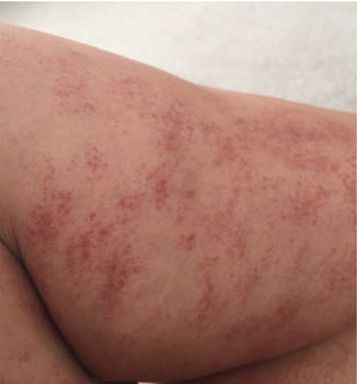 8 Types of Rashes That Can Be a Sign of COVID-19 | Health.com