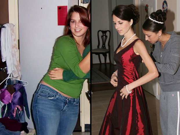 This Site Posted a Recovering Anorexic Woman's Photos as Weight-Loss Inspiration