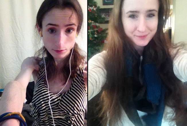 This Brave Anorexia Survivor Posted Shocking Recovery Photos on a Weight-Loss Thread